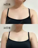ボトックス（肩） 湘南美容クリニック 西宮北口院 AFTER サムネイル用