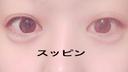 ヒアルロン酸注入（涙袋） しのぶ皮膚科 AFTER サムネイル用