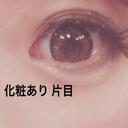 ヒアルロン酸注入（涙袋） しのぶ皮膚科 DAY 2 サムネイル用