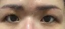 眉下切開 湘南美容クリニック 大阪京橋院 DAY 68 サムネイル用