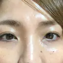 二重切開 / 眼瞼下垂（切開） / 上まぶたたるみ取り 湘南美容クリニック 高田馬場院 DAY 201 サムネイル用