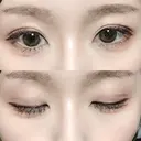 二重切開 松下皮フ形成外科 DAY 72 サムネイル用