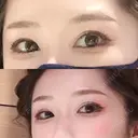二重切開 松下皮フ形成外科 DAY 74 サムネイル用