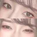 二重切開 松下皮フ形成外科 DAY 109 サムネイル用