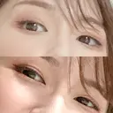 二重切開 松下皮フ形成外科 DAY 129 サムネイル用