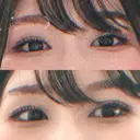 二重切開 松下皮フ形成外科 DAY 132 サムネイル用