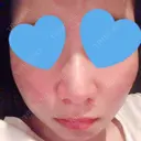 鼻尖形成（切開） / 小鼻縮小（切開） 湘南美容クリニック 神戸院 DAY 34 サムネイル用