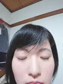 二重埋没 共立美容外科 札幌院 DAY 145 サムネイル用