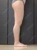 脂肪吸引（脚） 宇都宮竹内クリニック DAY 230 サムネイル用