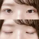 二重切開 松下皮フ形成外科 DAY 15 サムネイル用