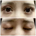 二重切開 / 上まぶたたるみ取り 城本クリニック 姫路院 DAY 51 サムネイル用
