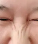 シワ取りボトックス 湘南美容クリニック 藤沢院 DAY 23 サムネイル用