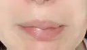 シワ取りボトックス 湘南美容クリニック 藤沢院 DAY 12 サムネイル用