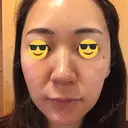 ダーマペン AURORA CLINIC（オーロラクリニック）新宿院 DAY 3 サムネイル用