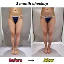 脂肪吸引（脚） / 脂肪吸引（お尻） Mods Clinic（モッズクリニック） 東京院 DAY 94 サムネイル用