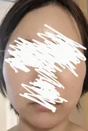 ボトックス（エラ・小顔） 湘南美容クリニック 静岡院 DAY 8 サムネイル用