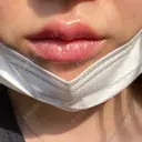 ヒアルロン酸注入（唇） / ボトックス（口角） アクトリー勝どきウェルネスメディカルクリニック DAY 61 サムネイル用
