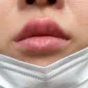 ヒアルロン酸注入（唇） / ボトックス（口角） アクトリー勝どきウェルネスメディカルクリニック AFTER サムネイル用