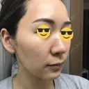 ダーマペン AURORA CLINIC（オーロラクリニック）新宿院 DAY 4 サムネイル用