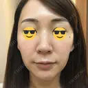 ダーマペン AURORA CLINIC（オーロラクリニック）新宿院 DAY 5 サムネイル用