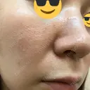 ダーマペン AURORA CLINIC（オーロラクリニック）新宿院 DAY 5 サムネイル用