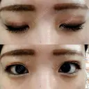 二重切開 / 上まぶたの脂肪取り TCB東京中央美容外科 江坂院 AFTER サムネイル用