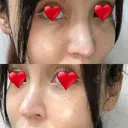 隆鼻術 / 鼻尖形成（切開） / 鼻中隔延長（切開） / 軟骨移植 / プロテーゼ除去 / 鼻修正 THE ROPPONGI CLINIC（ザ 六本木クリニック） DAY 92 サムネイル用