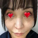 隆鼻術 / 鼻尖形成（切開） / 鼻中隔延長（切開） / 軟骨移植 / プロテーゼ除去 / 鼻修正 THE ROPPONGI CLINIC（ザ 六本木クリニック） DAY 92 サムネイル用