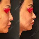 隆鼻術 / 鼻尖形成（切開） / 鼻中隔延長（切開） / 軟骨移植 / プロテーゼ除去 / 鼻修正 THE ROPPONGI CLINIC（ザ 六本木クリニック） DAY 92 サムネイル用