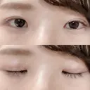 二重切開 松下皮フ形成外科 DAY 22 サムネイル用