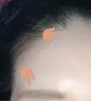 額を丸く / シワ取りボトックス / その他（肌） / その他（輪郭） 湘南美容クリニック 藤沢院 DAY 29 サムネイル用