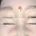 シワ取りボトックス 湘南美容クリニック 藤沢院 DAY 29 サムネイル用