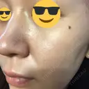 ダーマペン AURORA CLINIC（オーロラクリニック）新宿院 DAY 10 サムネイル用