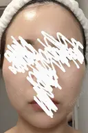 ボトックス（エラ・小顔） 湘南美容クリニック 静岡院 DAY 14 サムネイル用