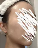 ボトックス（エラ・小顔） 湘南美容クリニック 静岡院 DAY 14 サムネイル用