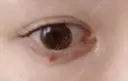 ヒアルロン酸注入（涙袋） アクトリー勝どきウェルネスメディカルクリニック DAY 12 サムネイル用