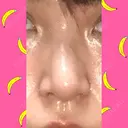 鼻尖形成（切開） / 小鼻縮小（切開） / 軟骨移植 / 鼻孔縁挙上 / 鼻尖縮小 ヴェリテクリニック 大阪院 DAY 31 サムネイル用