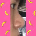 鼻尖形成（切開） / 小鼻縮小（切開） / 軟骨移植 / 鼻孔縁挙上 / 鼻尖縮小 ヴェリテクリニック 大阪院 DAY 31 サムネイル用