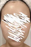 ボトックス（エラ・小顔） 湘南美容クリニック 静岡院 DAY 19 サムネイル用