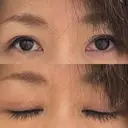 二重切開 / 上まぶたたるみ取り / 上まぶたの脂肪取り 松下皮フ形成外科 DAY 63 サムネイル用