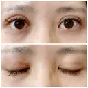 二重切開 / 上まぶたたるみ取り 城本クリニック 姫路院 DAY 66 サムネイル用