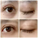 二重切開 / 上まぶたたるみ取り 城本クリニック 姫路院 DAY 66 サムネイル用