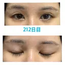 上まぶたの脂肪取り / 眉下切開 JUN CLINIC AFTER サムネイル用