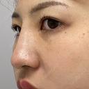 ヒアルロン酸注入（鼻） TCB東京中央美容外科 八王子院 DAY 0 サムネイル用