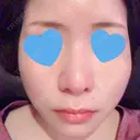 鼻尖形成（切開） / 小鼻縮小（切開） 湘南美容クリニック 神戸院 DAY 53 サムネイル用