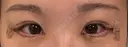 目尻切開 / タレ目形成・グラマラスライン（切開） / 目尻靭帯移動 アネシス美容クリニック DAY 4 サムネイル用