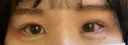 目尻切開 / タレ目形成・グラマラスライン（切開） / 目尻靭帯移動 アネシス美容クリニック DAY 7 サムネイル用