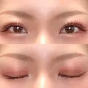 二重埋没 / 自然癒着法 シンデレラ＆ダヴィンチクリニック DAY 70 サムネイル用