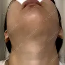 その他（輪郭） リラ・クラニオフェイシャル・クリニック DAY 94 サムネイル用