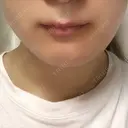 その他（輪郭） リラ・クラニオフェイシャル・クリニック DAY 94 サムネイル用